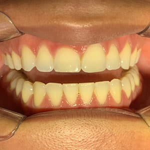 Cliente após o uso do aparelho invisível SouSmile