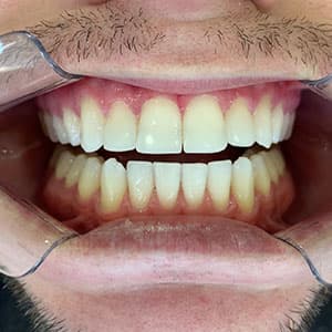 Cliente após o uso do aparelho invisível SouSmile