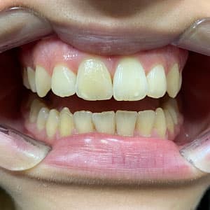 Cliente após o uso do aparelho invisível SouSmile