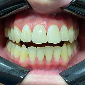 Cliente após o uso do aparelho invisível SouSmile