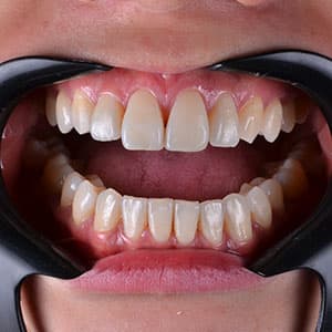 Cliente após o uso do aparelho invisível SouSmile