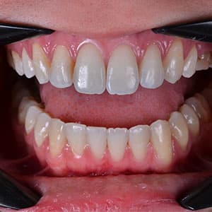 Cliente após o uso do aparelho invisível SouSmile