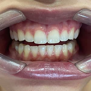 Cliente após o uso do aparelho invisível SouSmile