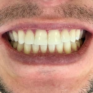 Cliente após o uso do aparelho invisível SouSmile