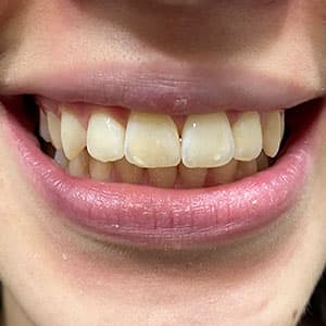 Cliente após o uso do aparelho invisível SouSmile