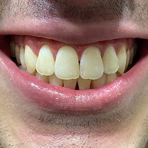 Cliente após o uso do aparelho invisível SouSmile