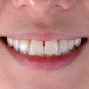 Cliente após o uso do aparelho invisível SouSmile