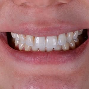 Cliente após o uso do aparelho invisível SouSmile