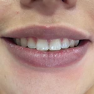 Cliente após o uso do aparelho invisível SouSmile