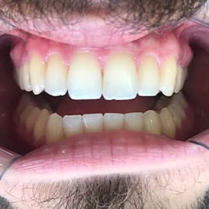 Cliente após o uso do aparelho invisível SouSmile