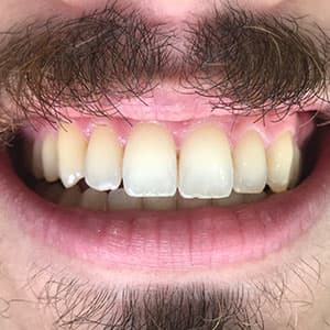 Cliente após o uso do aparelho invisível SouSmile